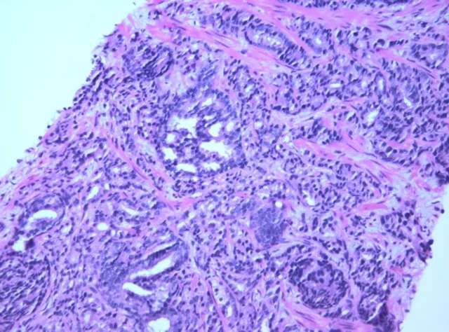 Predicting Prostate Cancer