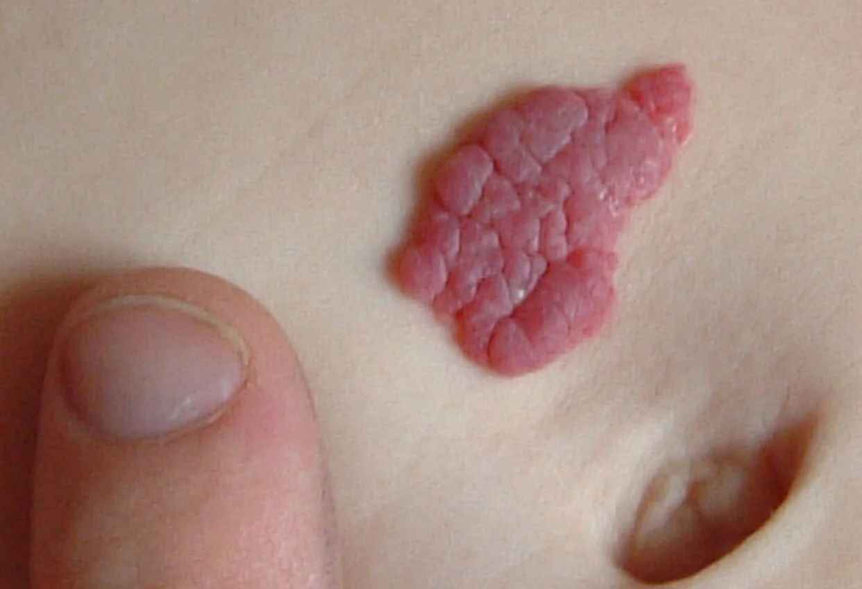 Learning about Hemangiomas