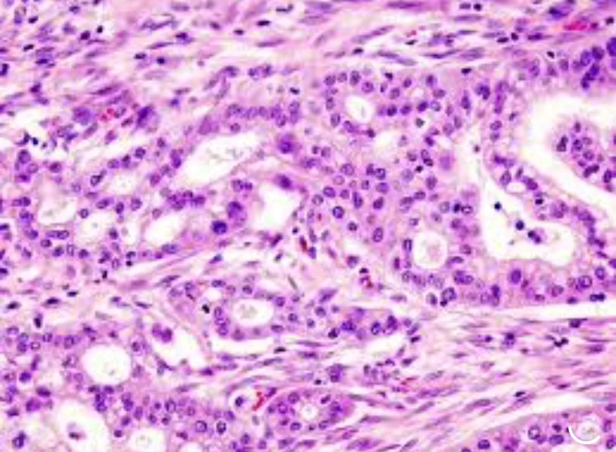 New class of compounds shrinks Pancreatic Cancer Tumors, Prevents Growth