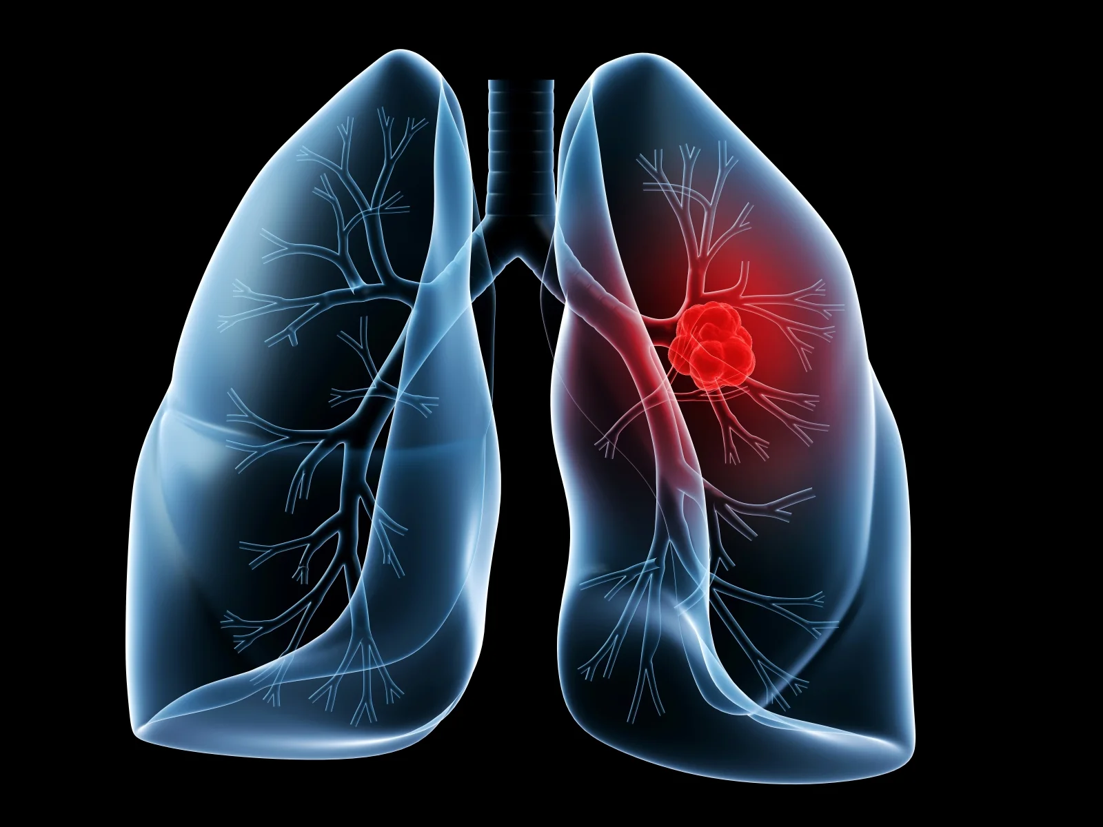 Warning Signs of Lung Cancer