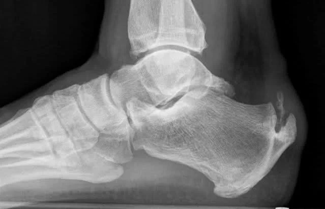 Bone Spurs and Bone Health