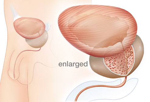 enlargedprostate.jpg