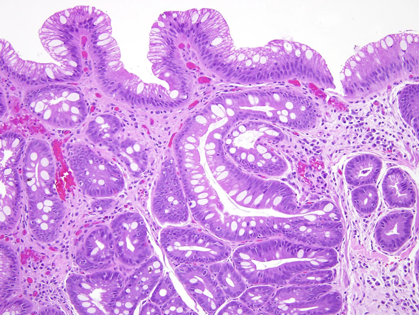 Barrett’s Esophagus