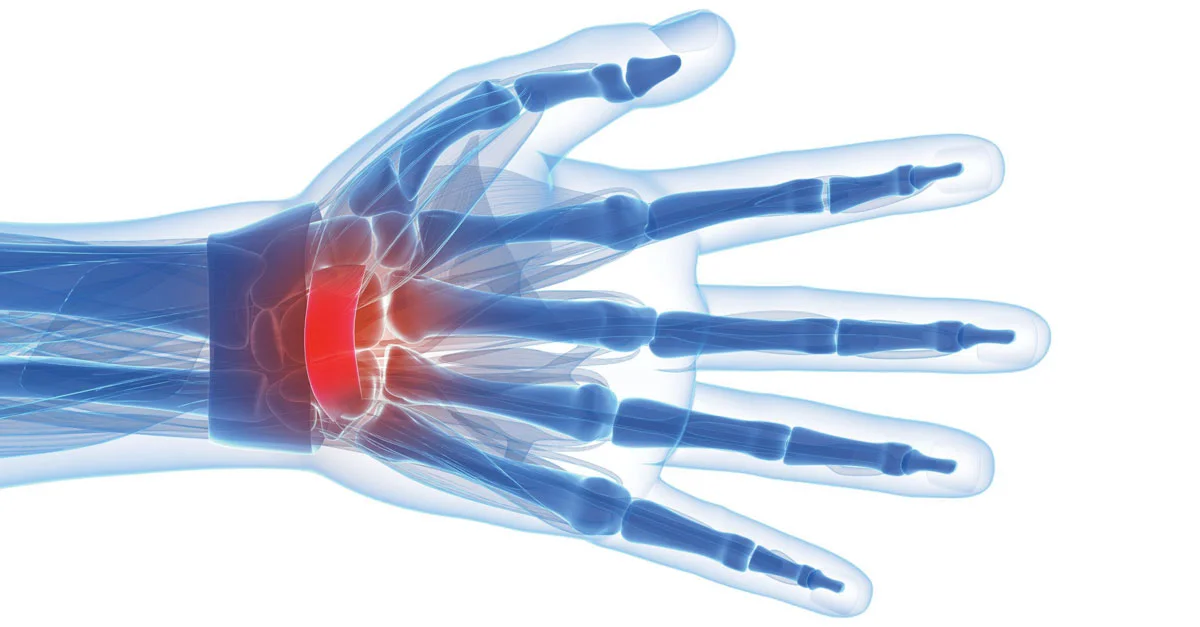 Here's the Risks for Carpal Tunnel Syndrome