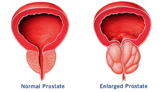 Enlarged Prostate? Here's what you need to know. 