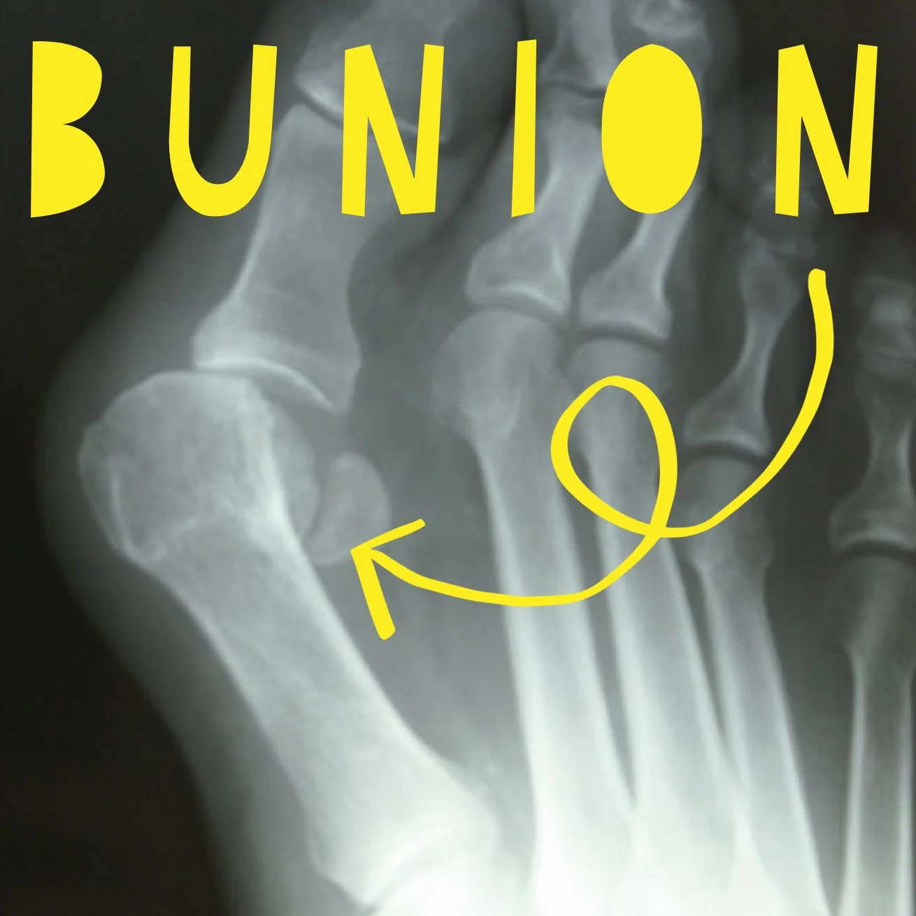 Your Foot Health: Understanding Bunions