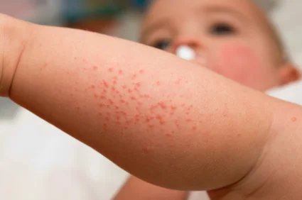 Itchy skin? Learn About Eczema