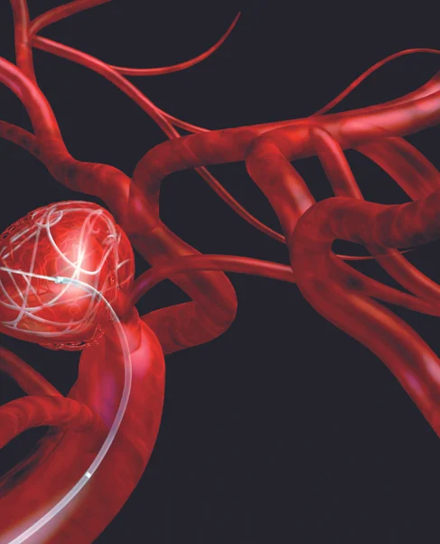 Brain Aneurysm: 3 million cases per year