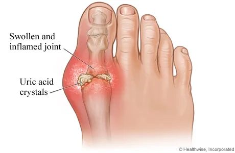 What is gout?