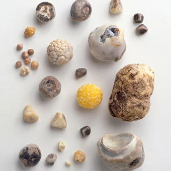 How Gallstones Are Detected