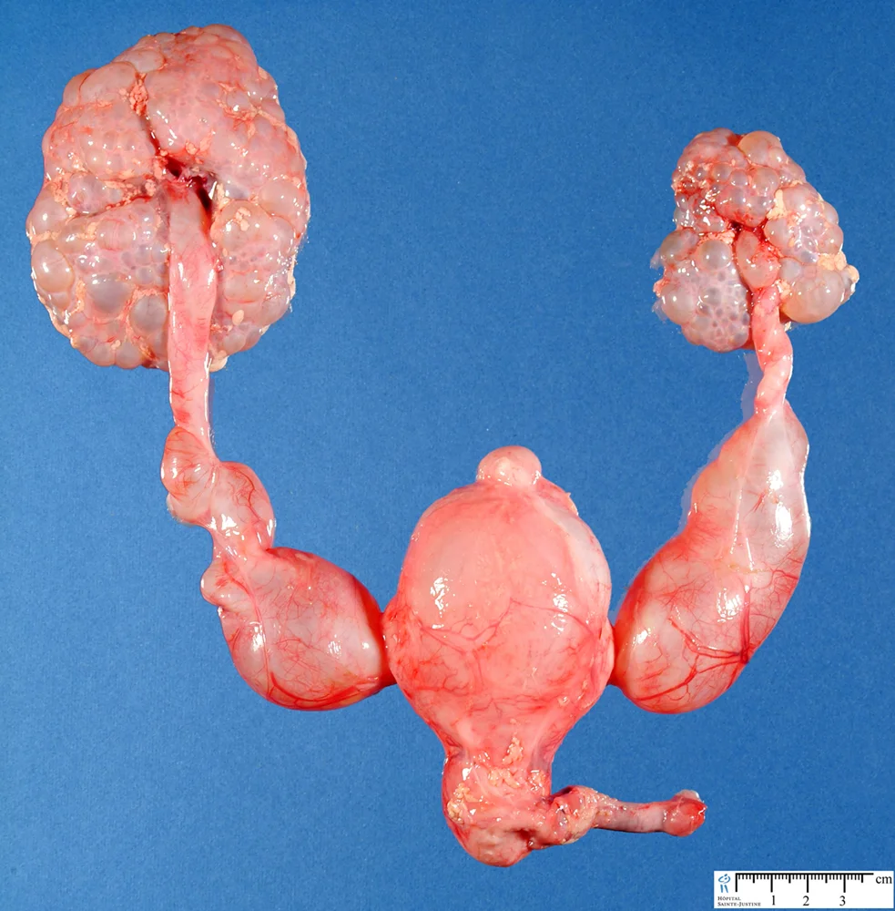 What is hydronephrosis?