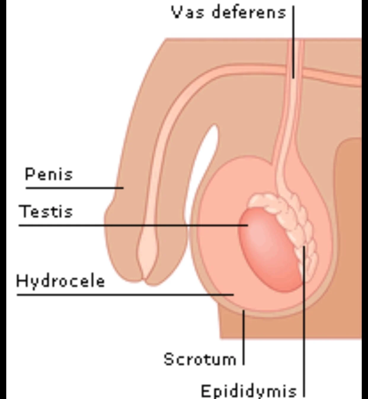 What is Hydrocele?