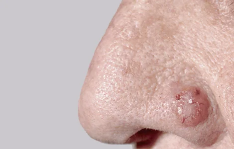 A Cancer You Can Prevent