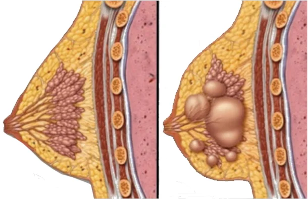 What is fibrocystic breast disease?