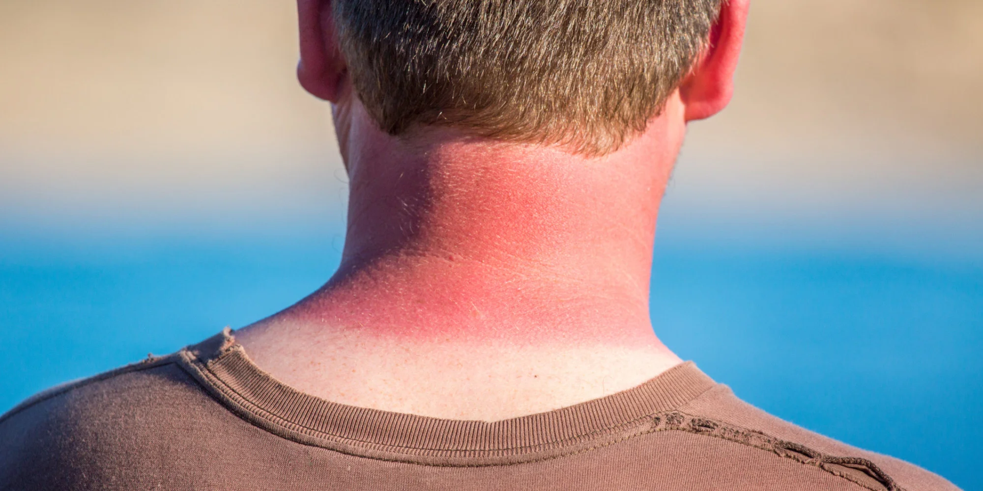5 Natural Sunburn Remedies