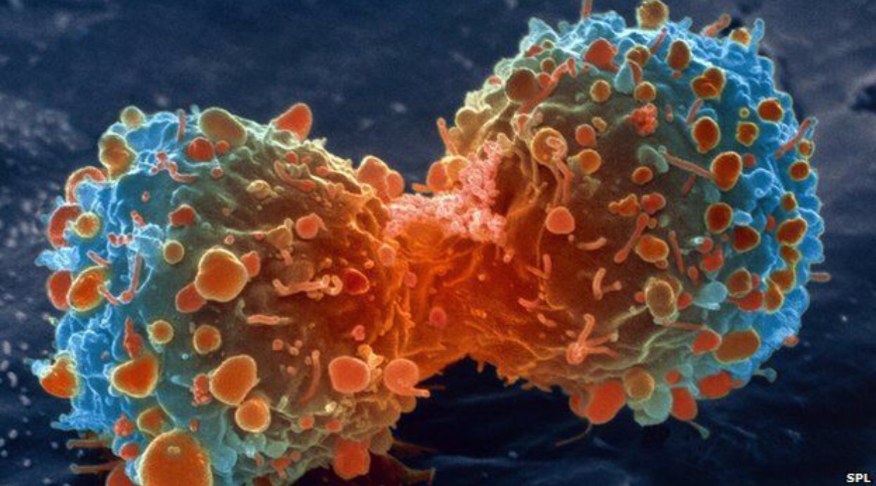 African American Patients Less Likely to Receive Chemo for Colon Cancer