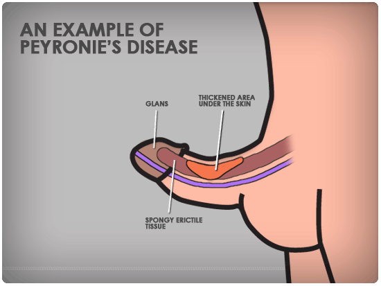 Learning About Peyronie's Disease