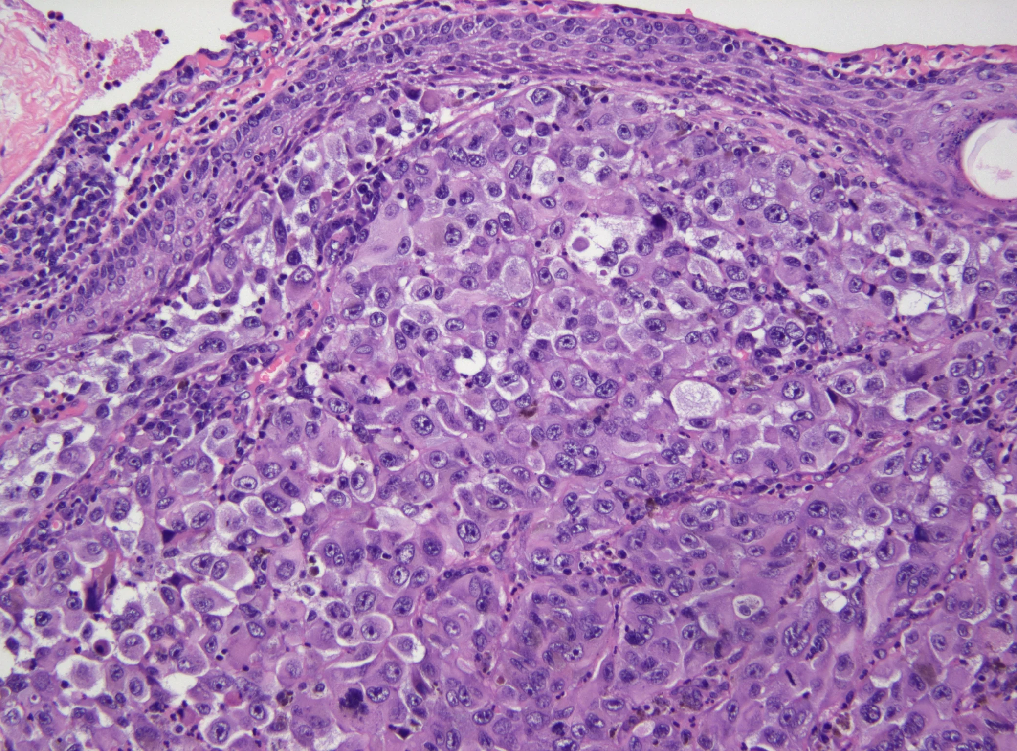 Melanoma: A Pathologist’s Perspective