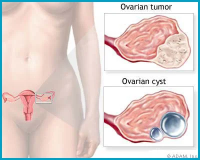 Do you have ovarian cysts?