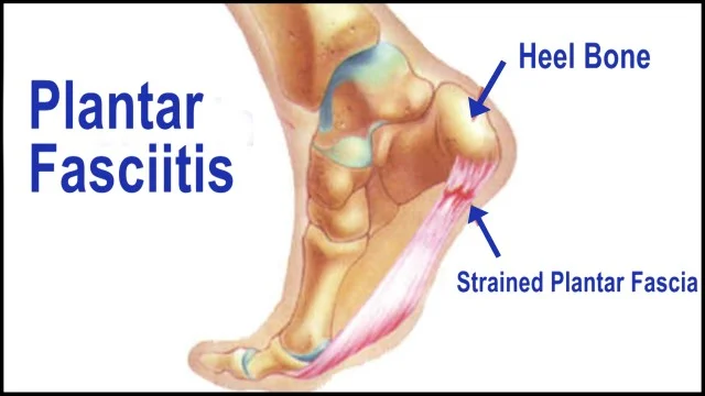 What is plantar fasciitis?