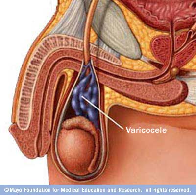 What is a varicocele?