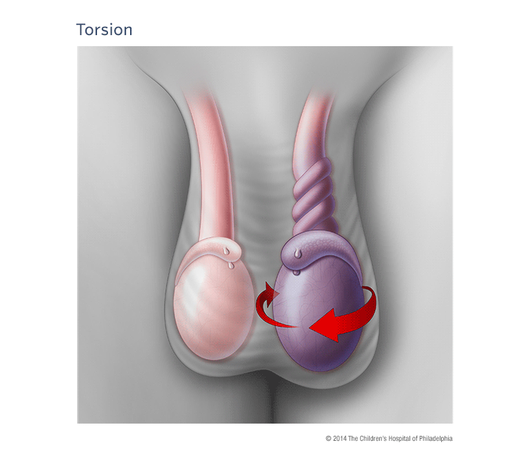 What is testicular torsion?