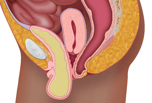 What It Means To Have A Prolapsed Bladder