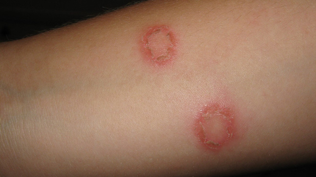Symptoms of Ringworm