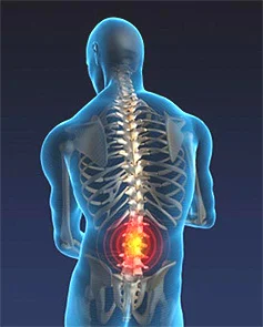What is spinal meningitis?