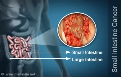What is small intestine cancer?