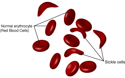 What is sickle cell disease?