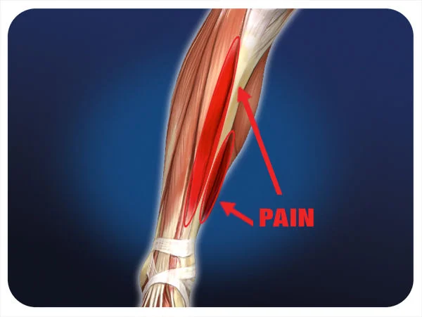 How We Get Shin Splints