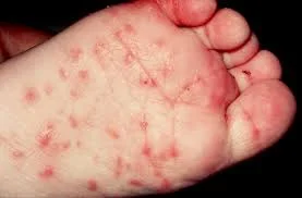 What You Need to Know About Scabies