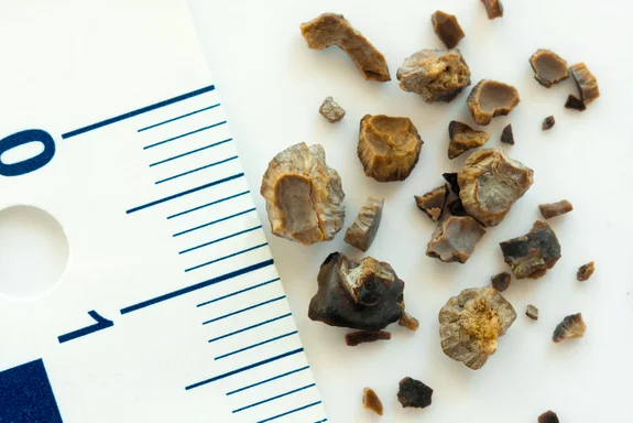 10 Surprising Risk Factors for Kidney Stones