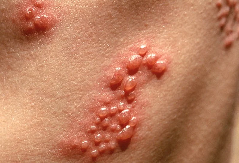 Understanding Shingles