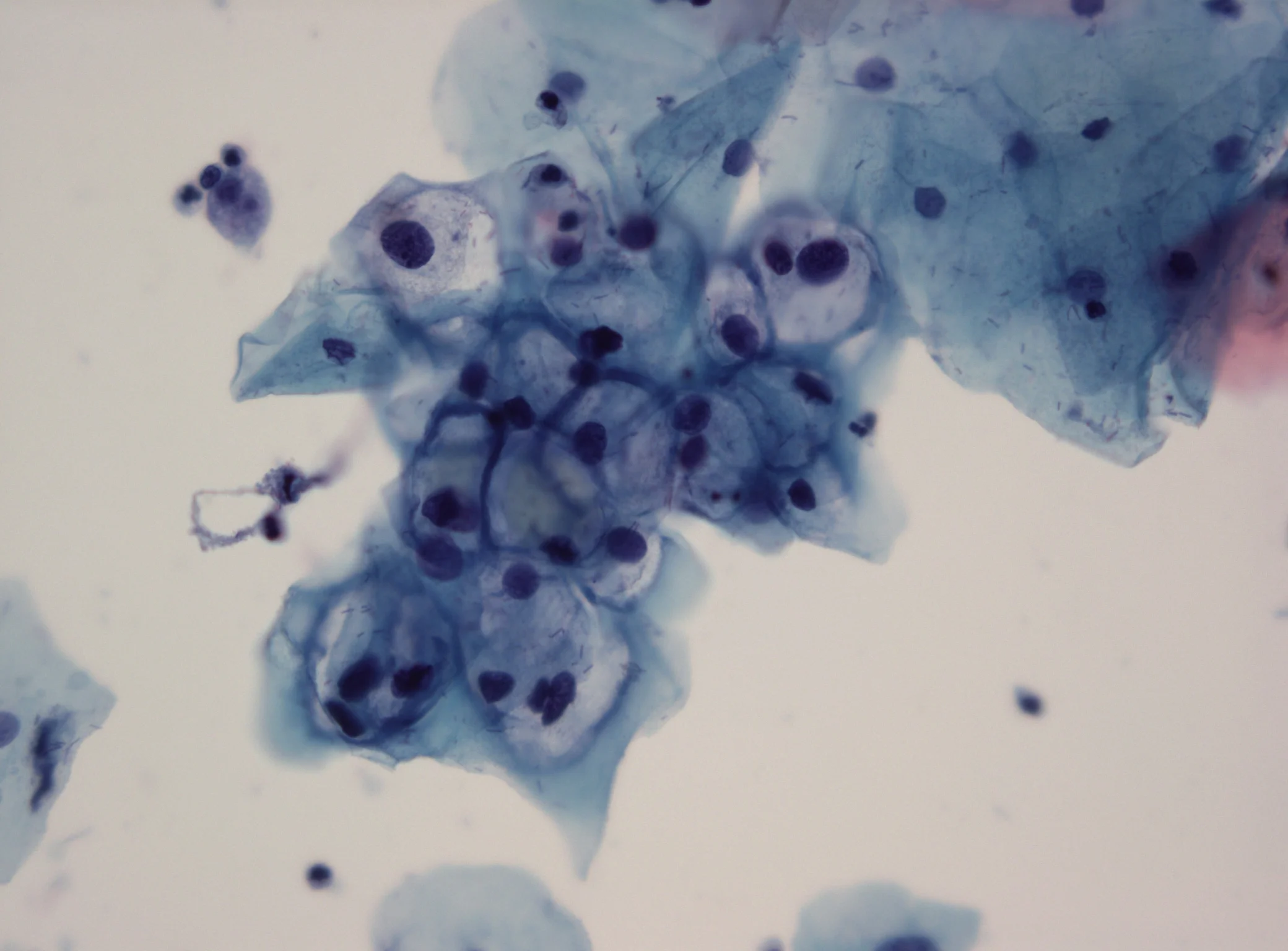 Cervical cancer screening: What you need to know