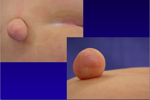 What is a benign lipoma?