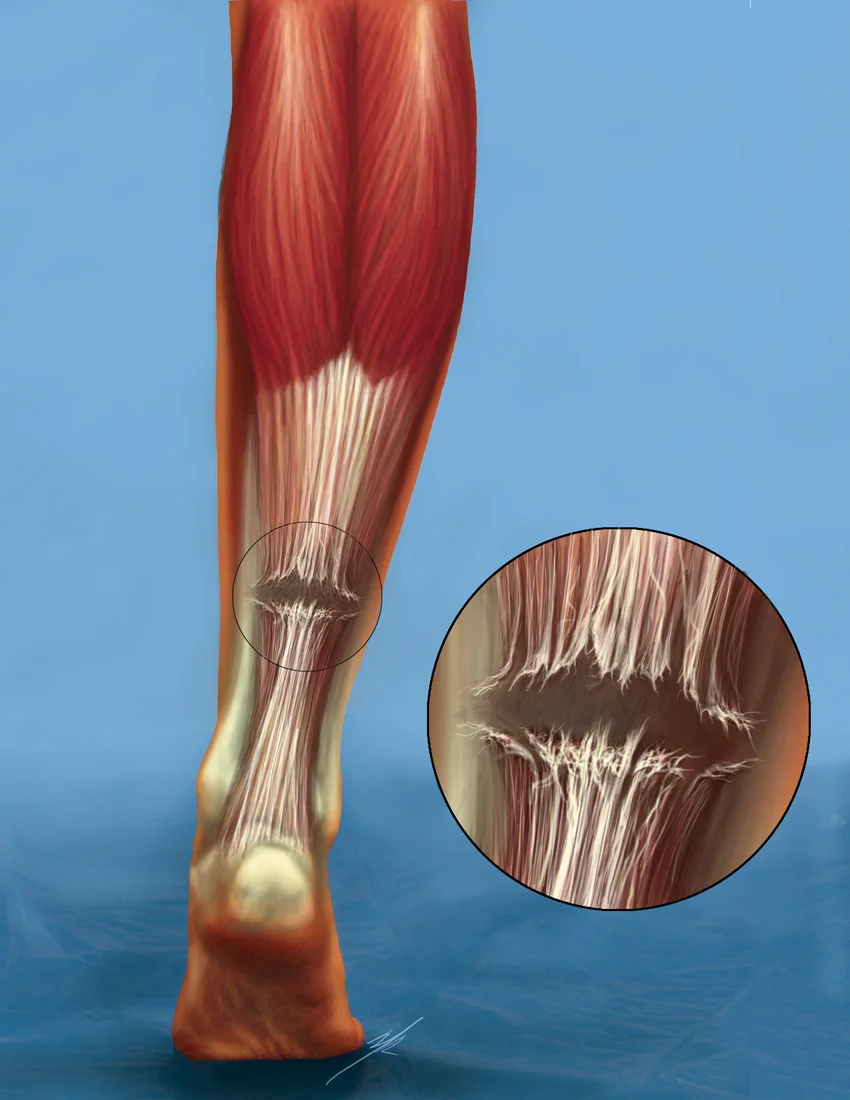 What is an Achilles tendon rupture?