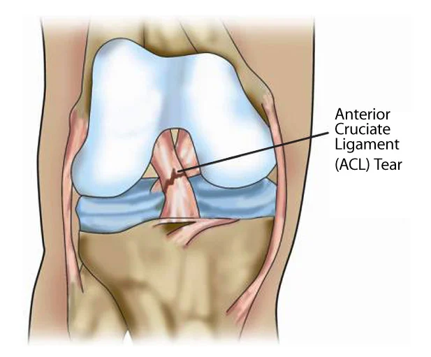What is an ACL injury?