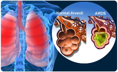 Acute Respiratory Distress Syndrome