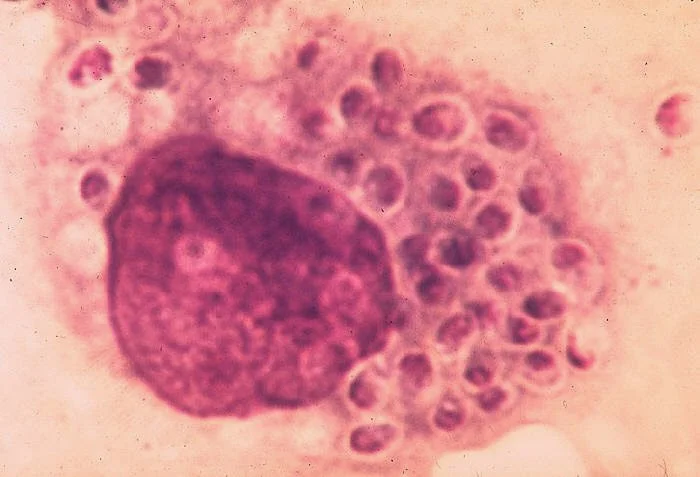 Understanding Histoplasmosis