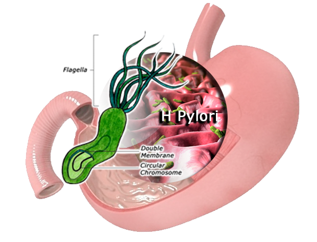 What is H. pylori infection?