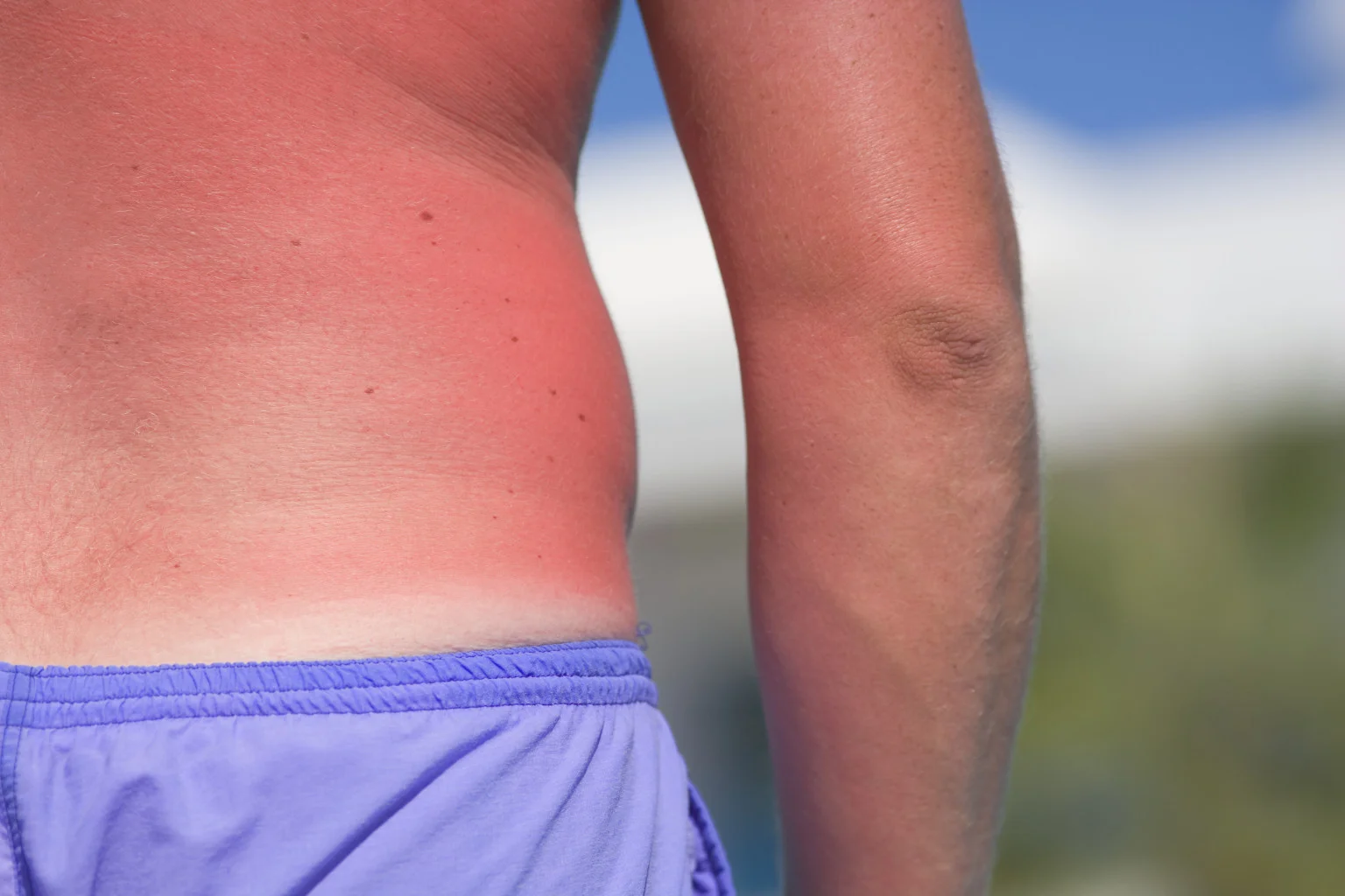 Home Remedies and Preventing Future Sunburns