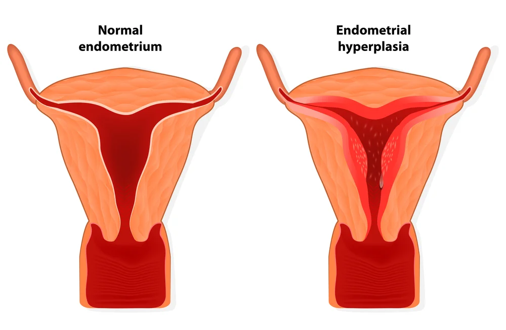 What is Menorrhagia?