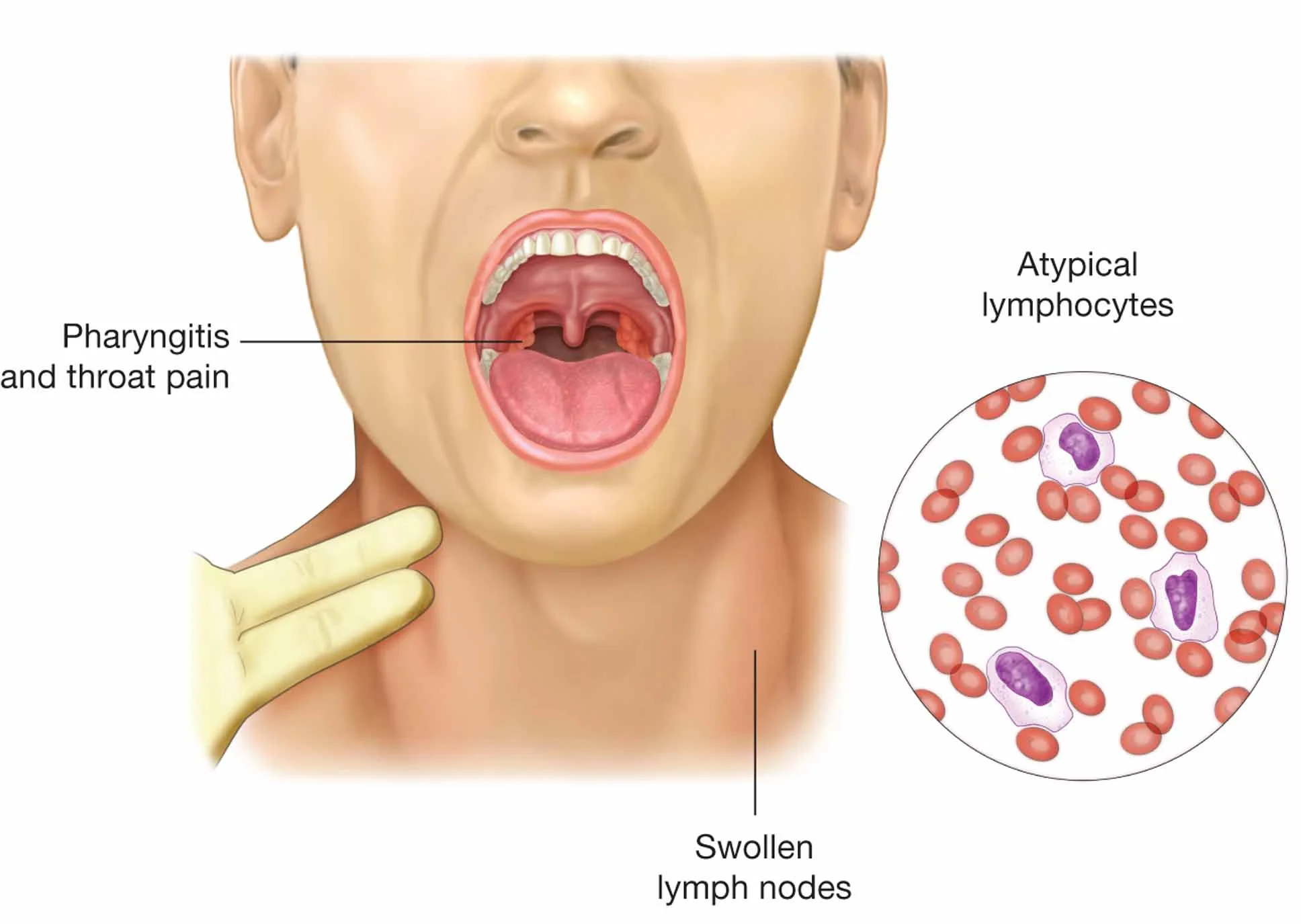 Do you have mononucleosis?