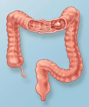 What is intussusception?