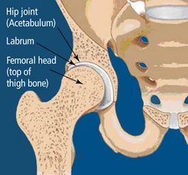 What is a hip labral tear?