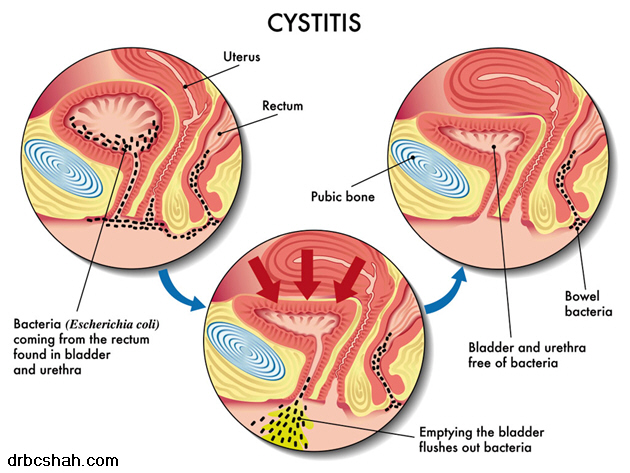 Do you have cystitis?