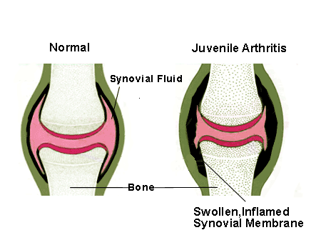 Juvenile Rheumatoid Arthritis