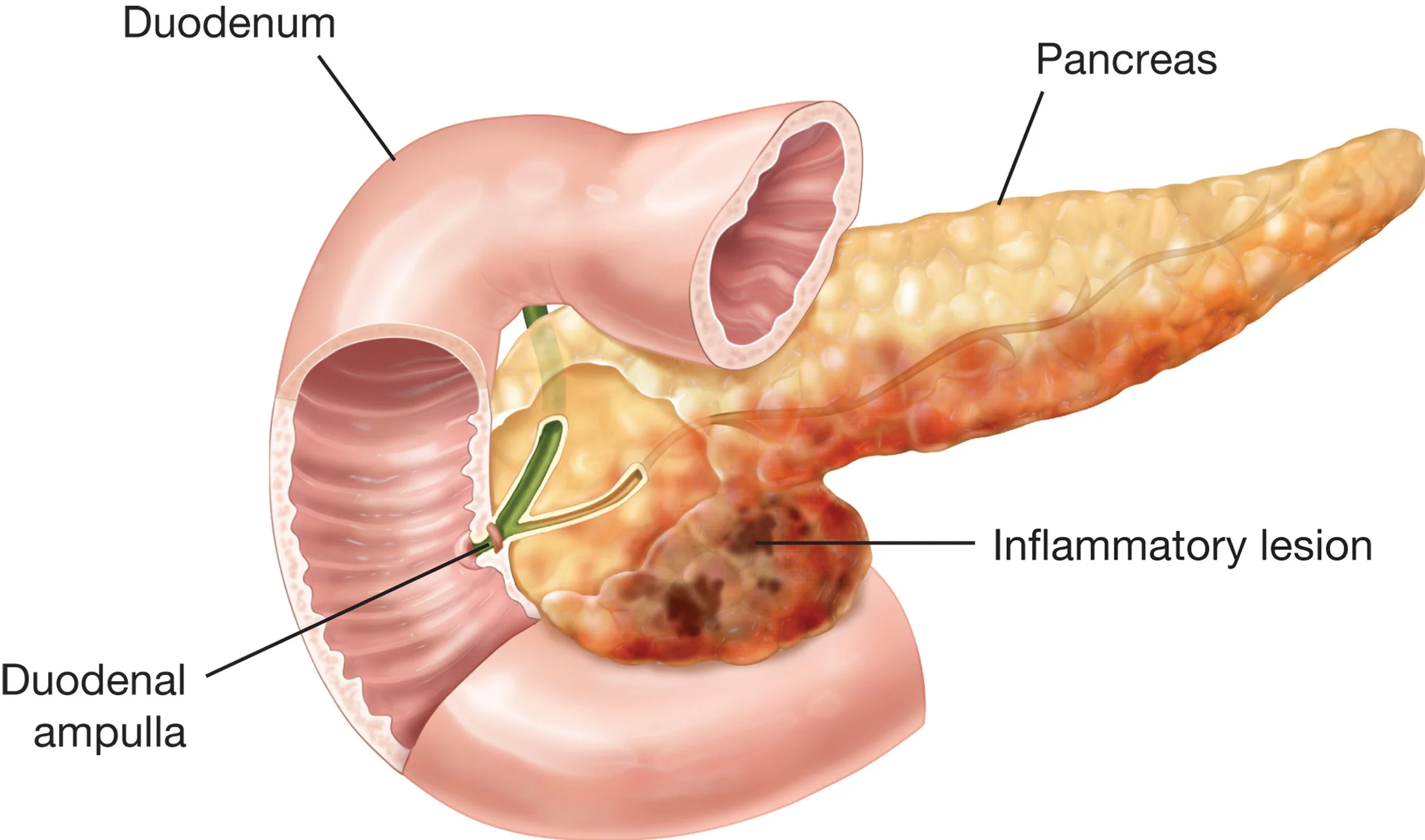 What is pancreatitis?